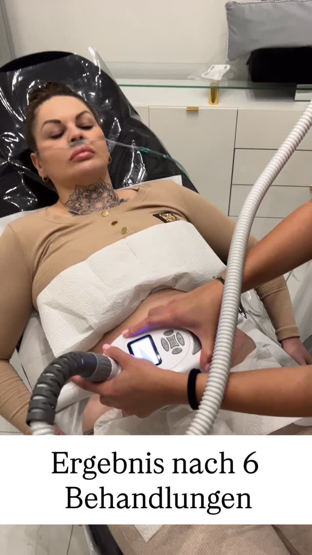 VelaShap3
Wie funktioniert die VelaShape3 Behandlung?
VelaShape3 ist eine nicht-invasive Behandlung zur Reduktion von Cellulite 🍊 und zur Körperformung 🔥. Dabei kommen Infrarotlicht (IR), Radiofrequenzenergie (RF) sowie eine Vakuumtechnik zum Einsatz – kombiniert mit einer mechanischen Lymphdrainage 💆♀️. Diese Kombination erwärmt gezielt das Fettgewebe, fördert die Durchblutung ❤️, regt den Lymphfluss an 💧 und stimuliert die Bildung von Kollagen 💪.
✨ Das Ergebnis: glattere Haut, eine sichtbar straffere Silhouette und eine spürbare Reduktion von Cellulite‼️
Wie viele Behandlungen braucht man?
Nur 4 bis 6 Sitzungen reichen aus, um sehr gute und sichtbare Resultate zu erzielen 💯.
Die Behandlung ist schmerzfrei und dauert pro Zone nur ca. 15 Minuten ⏱️ – perfekt für deinen vollen Alltag‼️
Wie lange halten die Ergebnisse an?
Die Wirkung ist nicht nur sichtbar, sondern auch wissenschaftlich nachgewiesen 📊:
Studien belegen, dass die Resultate mehrere Monate bis zu einem Jahr anhalten können – ganz ohne OP! 🛑
In Kombination mit einem gesunden Lebensstil 🥗 und regelmäßiger Bewegung 🚶♀️ lässt sich der Effekt sogar noch verlängern.
👉 Für ein dauerhaft schönes Ergebnis empfehlen wir Auffrischungsbehandlungen alle paar Monate.
⸻
#velashape3 #bodycontouring #lymphdrainage #beautyhamburg