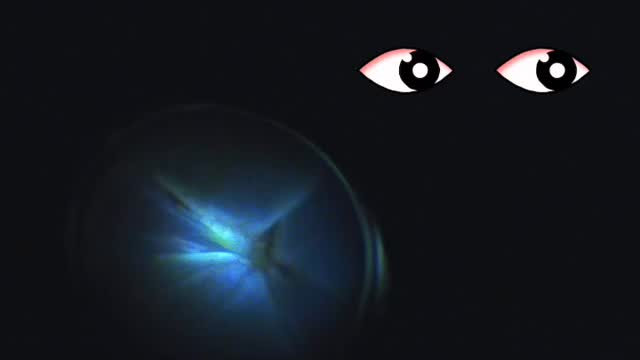 A case of a total closed funnel retinal detachment redo surgery with hypotony and small pupil.
The video of the surgery going in and out of view was not about a patient blinking or the microscope lights going on or off.
It highlights the challenge in these cases where you have to view through a small pupil and maintain primary eye position while carefully removing the proliferative vitreoretinopathy membrane off the retinal surface so that all the traction on the retina is relieved. Therefore, any small movements out of the primary position will make the view go completely.
#vitreoretinal #retinaldetachment #proliferativevitreoretinopathy #retina #eyedoctorchng