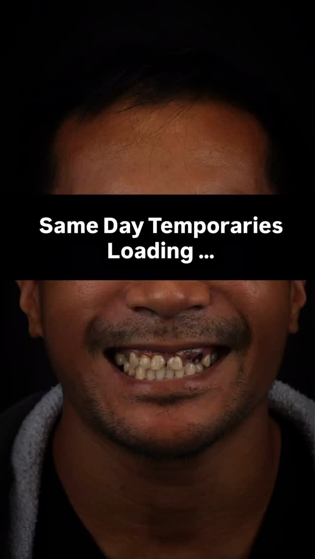 Can you believe these are just his TEMPORARIES?? 🤯 We were able to provide this amazing transformation the same day in one appointment! We cannot wait for the final result! #smiletransformation #orlandodentist #conwaysmilesorlando