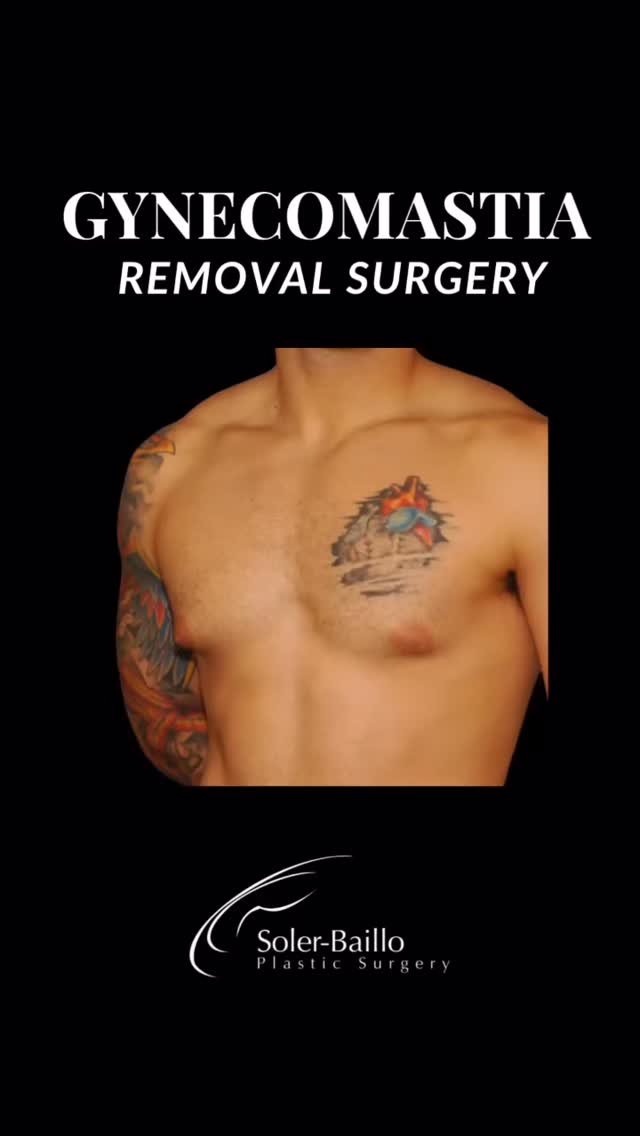 💪Male chest sculpting done right.
Gynecomastia surgery by Dr. Soler-Baillo reduces excess breast tissue to create a firmer, flatter chest with natural definition. Ideal for men dealing with hormone-related or stubborn genetic gynecomastia.
✨Ready to feel confident shirtless again?
📱Call 305-661-1996 | Located in Coral Gables
#gynecomastiasurgery #drsolerbaillo #plasticsurgerymiami #gynecomastiabeforeandafter #gynecomastiaremoval