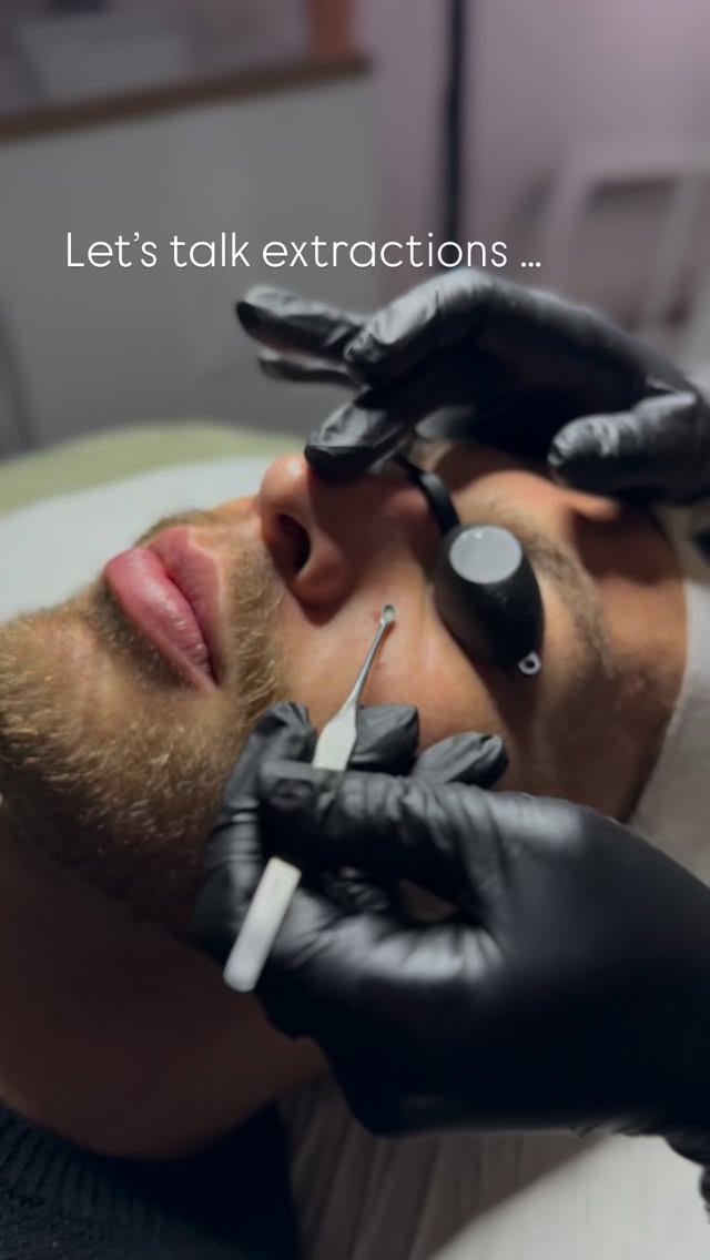 Think your skinâs clean? Letâs talk extractions.
Under the surface of your skin lives a build-up of oil, dead skin cells, makeup, pollution, and whatever else life throws at your face. Over time, that build-up clogs your pores - hello blackheads, congestion, breakouts, and dullness.
Professional extractions safely remove all that gunk without damaging your skin barrier. No squeezing at home. No scarring. Just clear pores, smoother texture, and a face that can actually breathe again.
Itâs grossly satisfying. Itâs oddly addictive. And yes, your skin will thank you.
Ready to decongest properly? DM to book your facial.
#extractions #facialcheltenham #clearskinloading #blackheadremoval #nineteenbeauty cheltenhamsalon skinreset