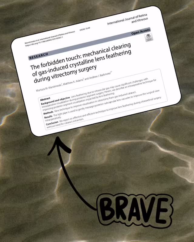 Interesting technique on how to clear up the crystalline lens during vitrectomy when lens feathering occurs. Quite impressive and definitely have to really brave with gentle movements to avoid a lens breach. Video is available at the website.
#vitrectomy #gascataract #internationaljournalofretinaandvitreous #ophthalmology #eyedoctorchng