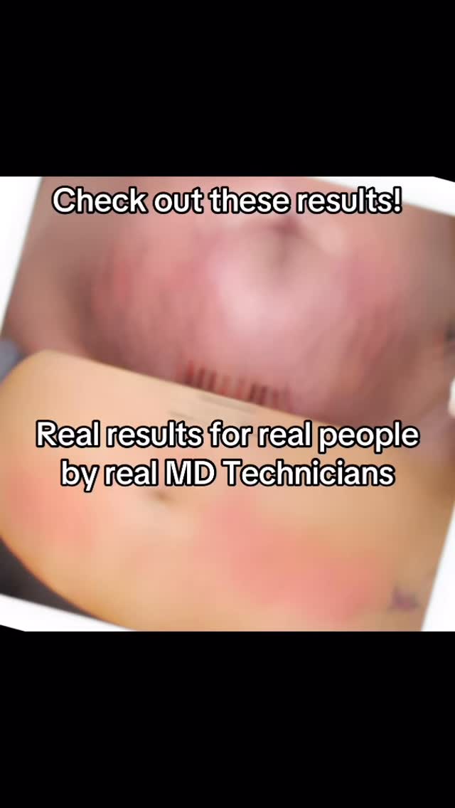 Million Dollar Body Glow-Up Offer āØ
Ready to feel firmer, smoother and summerāready from head to toe? These results are from fellow Million Dollar Technicians⦠and now Iām opening up exclusive spaces to build my own Million Dollar Body portfolio.
For Jan & Feb bookings only, Iām offering:
š„ 35% off a full Million Dollar Body course
š„ Ā£52 per treatment instead of Ā£80
š„ 6āmonth transformation plan (one treatment per month)
To access this offer, youāll:
šø Agree to let me capture and share your progress
š
Commit to the full 6ātreatment programme
⨠Be suitable for microneedling treatments
š Be ready for a real, visible body glowāup
Spaces are limited so I can give each client proper attention.
If you want to start your summer body now, drop me a message and Iāll get you booked in.
Letās create your Million Dollar results together āØ
Offer available for Body treatments only
#skintightening #fyp #selfcare #glowup #cambridgeshire