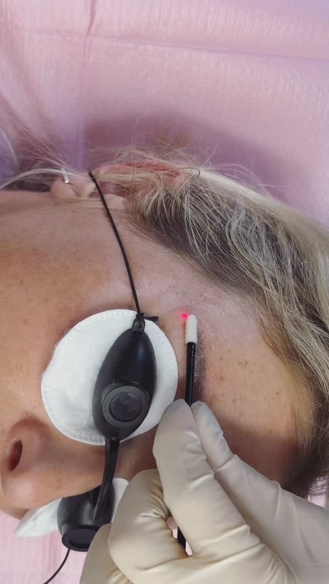 💁♀️ Make brow ready for #hairstrokebrows 🤩🤩!
#tattooremoval #laserremoval #wellington #wellingtoncosmetictattoo