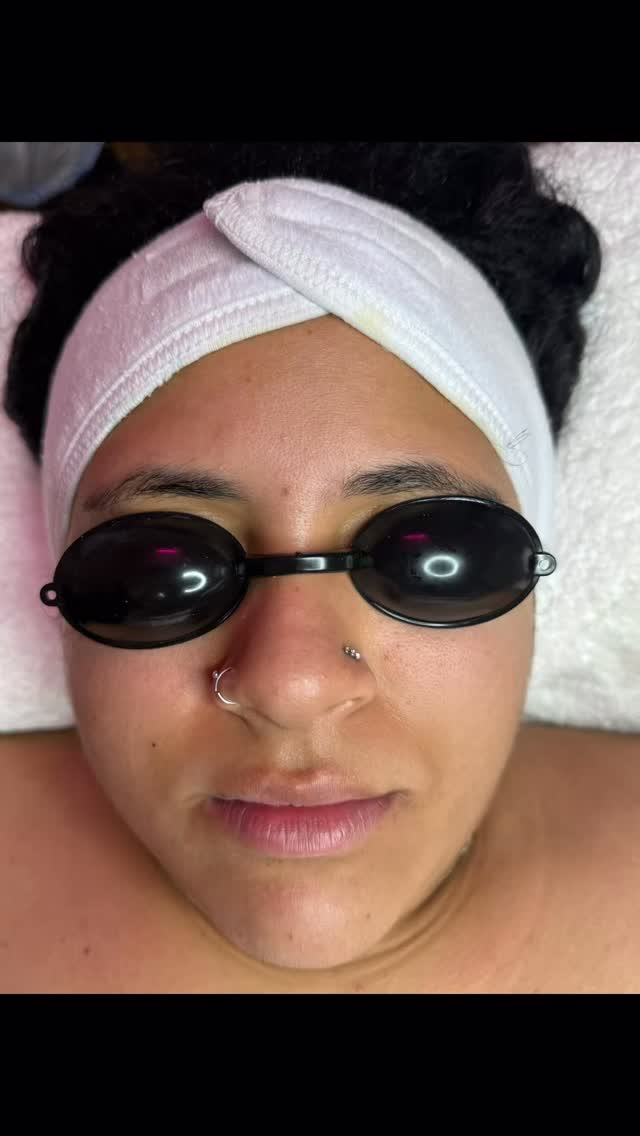 Before & after #Dermaplaningfacial #glowingskin ✨