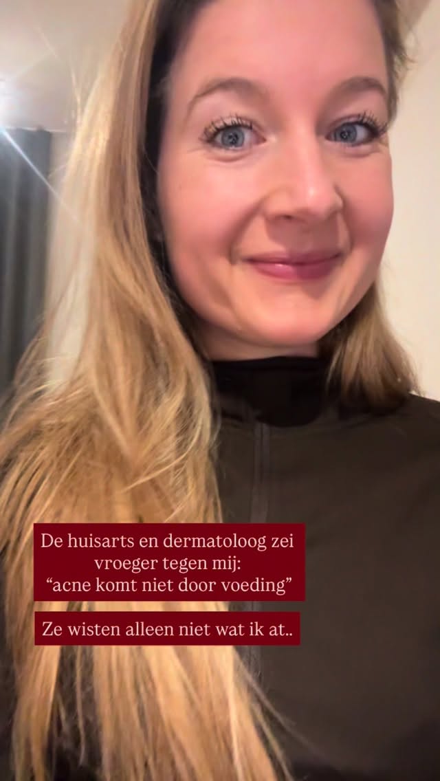 Wist ik 15 jaar geleden maar wat ik nu weet..
Voeding heeft een enorme impact op acne. Ik weet inmiddels precies waar mijn huid op reageert.
Acne is geen domme pech, het is een ontstekingsbeeld en het komt van binnenuit.
Het inzichtelijk maken van bloedwaarden zoals vitamines, mineralen, hormonen en intoleranties kan ál het verschil maken.
Stop met heftige anti biotica kuren en crèmes; ga opzoek (met hulp) naar de oorzaak. Want er is een oorzaak!
Wist ik toen maar wat ik nu wist.. dat had me zoveel onzekerheid bespaard.
Als je nu last hebt van acne; i feel you! Zoek hulp, het kan echt! Je mag me altijd een DM sturen ❤️