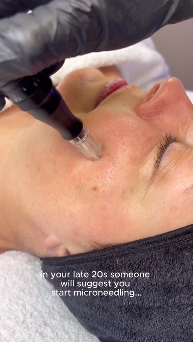If you’re 25+ and wanting to start banking some collagen, now is the time! From the age of 30, you start to lose 1% of collagen every year - resulting in signs of aging kicking in prematurely including fine lines and wrinkles, loss of elasticity and contours and overall skin aging.
By incorporating in Microneedling into your lifestyle, it will help to promote collagen production, whilst also increasing your product absorption (meaning your skincare’s gonna work a heck of a lot better) and reducing signs of skin aging
This treatment is best recommended in courses of treatment in order to see long-lasting results. For more info, please get in touch📩
#microneedling #antiagingskin #collageninductiontherapy #skinclinicmanchester #skinclinicaltrincham