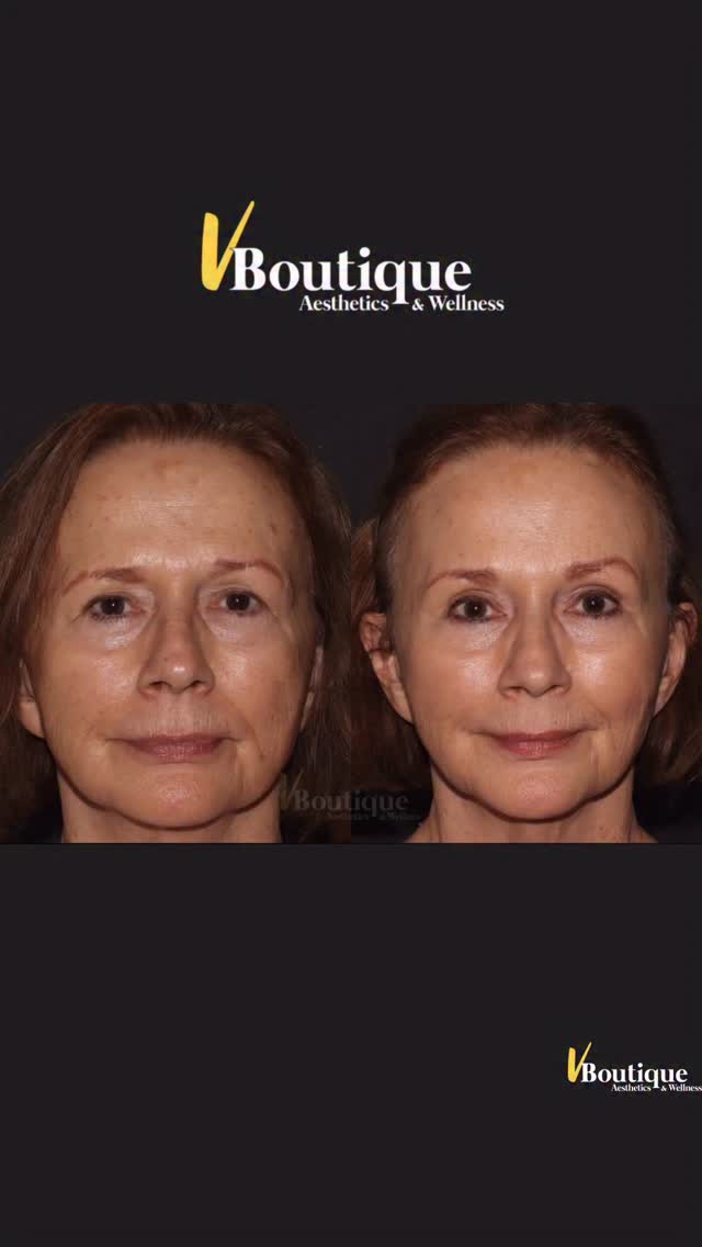 ✨ One Month Post-Resurfacing Laser ✨
This transformation speaks for itself — clarity, glow, smoother texture, softened lines, and visible tightening 💫
This patient underwent an advanced resurfacing laser combining multiple wavelengths, including Nd:YAG and Erbium, to precisely target:
✨ Sun damage & hyperpigmentation
✨ Broken capillaries
✨ Texture irregularities
✨ Fine lines & early wrinkles
✨ Benign skin lesions
🧬 The science behind it:
Erbium laser works by precisely ablating the top layers of damaged skin with incredible accuracy, while delivering controlled heat to the deeper layers. This stimulates new collagen production, accelerates cellular turnover, and reveals fresh, healthier skin beneath. The Nd:YAG complements this by targeting vascular issues and deeper pigment — all while preserving surrounding tissue.
🔥 The result?
• Smoother texture
• Brighter, clearer skin
• Improved firmness
• Natural, radiant glow
Because this treatment is highly adjustable, it can be tailored to your lifestyle and downtime needs. In this case, we used a slightly more aggressive setting, resulting in about 5–7 days of peeling and redness — and the results were absolutely worth it. She is thrilled 😍
🌱 Healing matters just as much as the laser itself.
We paired this treatment with:
✔️ Strategic pre- and post-procedure skincare
✔️ Immediate exosome (stem-cell-derived) application, which helped reduce downtime, accelerate healing, and enhance final results
⚠️ These are advanced medical laser treatments that must be performed by an experienced provider who truly understands how to combine multiple lasers safely and effectively — without risking burns or skin damage — to create results like this.
❄️ Pro tip: Winter is the best time to resurface your skin 🌨️
Less sun exposure = safer healing and better results (UV damage is still possible year-round, but winter gives us a huge advantage ☀️🚫)
#fotonausa #laserresurfacing #co2laser #SkinRejuvenation
#winterskinreset