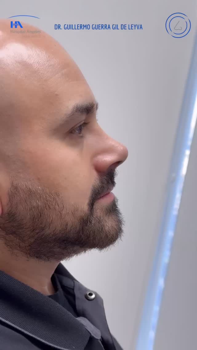 🔹 Tu satisfacción es nuestra prioridad. Cada Rinoplastia es diseñada para ti, considerando tus facciones y deseos.
🔹Evolución a un mes de Cirugía Nasal Estética y Funcional.
🔹 Gracias a mi excelente paciente por su confianza y permitir compartir su resultado.
🔹”Made by hand. Crafted with passion”
🧑⚕️ Dr. Guillermo Guerra Gil de Leyva
🏥 Hospital Ángeles Valle Oriente
📱 81-1252-0132
🎓Universidad de Monterrey
👃 Rinoplastia Estética y Funcional
🚫 No taponamiento
Cédula Profesional: 3070499
Cédula Especialista: 4503273
No. Certificación CONACEM: GUG-1748/04
Aviso de Publicidad COFEPRIS: 2419032002A00111
❕Paciente autoriza difusión de imágenes con fines académicos e informativos.
❕Los resultados finales se pudieran observar hasta un año de la cirugía y dependerá tanto del compromiso del cirujano como del paciente, así como del tipo de cirugía, tipo de piel, cuidados post-operatorios, etc.
#RinoplastiaPersonalizada #TuNarizTuEstilo
#rinoplastia #rhinoplasty #septoplastia #septoplasty #rinoseptumplastia #rhinoseptoplasty #nosejob #nose #nosesurgery #tabiquenasal #otorrinolaringologia #entsurgery #cirugianasal #cirugiatabique #cirugiaesteticanasal
#belleza #confianza #autoestima
#cosmeticsurgery
#otorrinolaringologiamonterrey #otorrinomonterrey #beforeandafter #antesydespues
#estructuredrhinoplasty
#rinoplastiaestructurada
#rinoplastiaultrasonica
#ultrasonicrhinoplasty