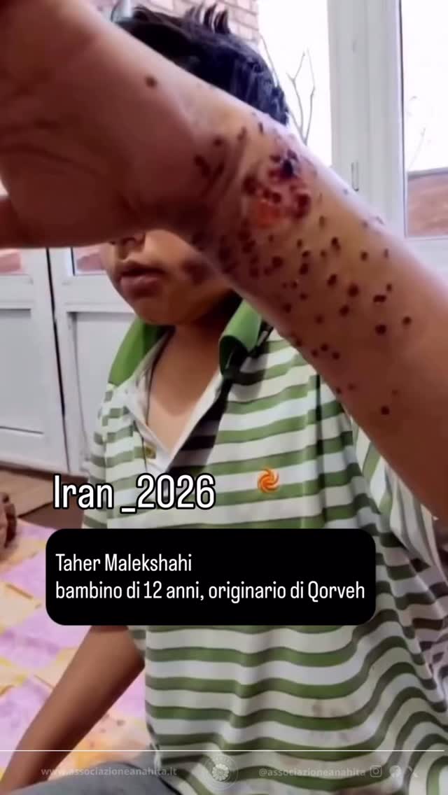 Un bambino di 12 anni, di nome Taher Malekshahi, è stato colpito a distanza di un metro da colpi a pallettoni sparati dai mercenari della Repubblica Islamica l’8 gennaio 2026.
#rivoluzioneiran2026