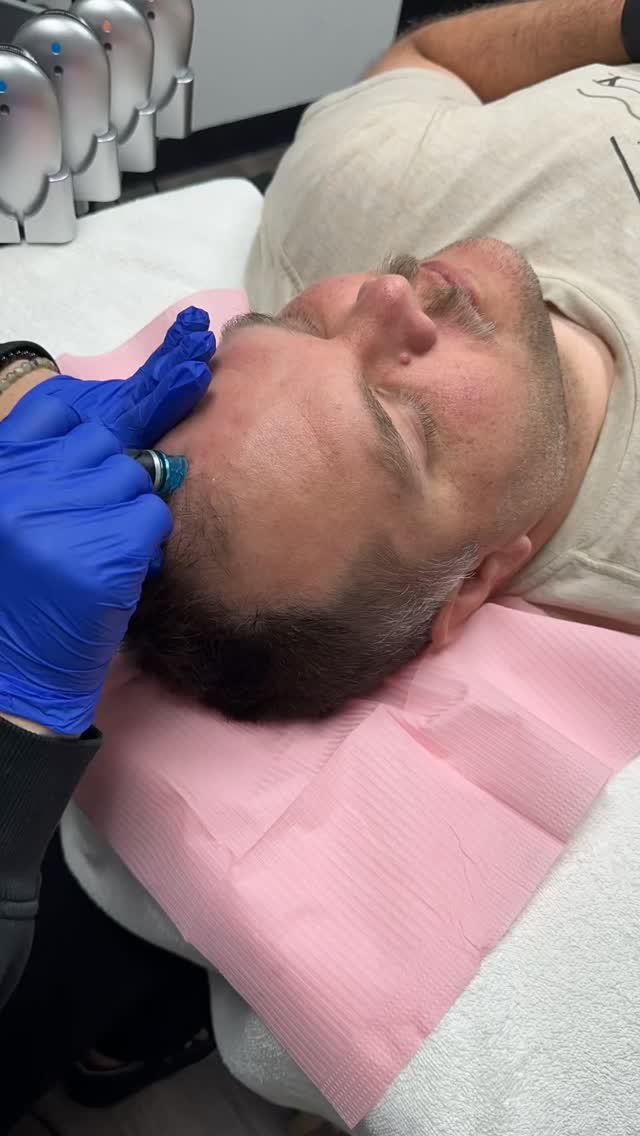 Let’s regrow some hair ✨
Step 1: @hydrafacial clears blocked follicles
Step 2: @procelltherapies microneedling + growth serum stimulates new hair growth
Healthy hair starts with your scalp
#hairtreatment #hydrafacial #procell #microneedling #scalpcare