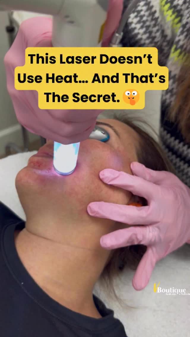 ✨ Watch until the end to see real examples of our Pico laser rejuvenation ✨
What you’re seeing here is Pico Laser technology using the advanced Fotona StarWalker — one of the most sophisticated pico systems available today.🙌🏻
🧠 Unlike traditional lasers that rely mainly on heat, pico lasers work through photo-acoustic energy. That means ultra-short pulses (picoseconds!) create sound waves, not thermal injury. These acoustic shockwaves gently shatter pigment and stimulate the skin from within — without overheating surrounding tissue.
🔬 Why StarWalker Pico is different:
• Combines multiple wavelengths for precision targeting
• Delivers extremely high peak power with ultra-short pulse duration
• Allows customized treatments for pigmentation, texture, pores, acne scars, and overall rejuvenation
• Exceptionally safe for darker skin tones 🌎✨
• Minimal risk of post-inflammatory hyperpigmentation compared to heat-based lasers
🎯 What it does for your skin:
✔️ Breaks up stubborn pigment (sun spots, melasma, discoloration)
✔️ Stimulates fibroblasts → up-regulates collagen & elastin
✔️ Improves texture, tone, and radiance
✔️ Creates gradual tightening and long-term skin quality improvement
❤️ About the redness you see:
You may notice mild redness or pinpoint bleeding immediately after treatment — this is a mechanical response, not heat damage. Because no thermal injury is created, swelling is usually minimal and recovery is fast.
⏳ Downtime & results:
Most redness resolves in 2–3 days ⏱️
Patients quickly notice:
✨ brighter glow
✨ softer pigmentation
✨ smoother texture
✨ improved firmness over time
This is advanced, physics-based rejuvenation — working with your skin, not burning it 🔊⚡
#PicoLaser #FotonaStarWalker #LaserRejuvenation #PigmentationTreatment #MelasmaTreatment