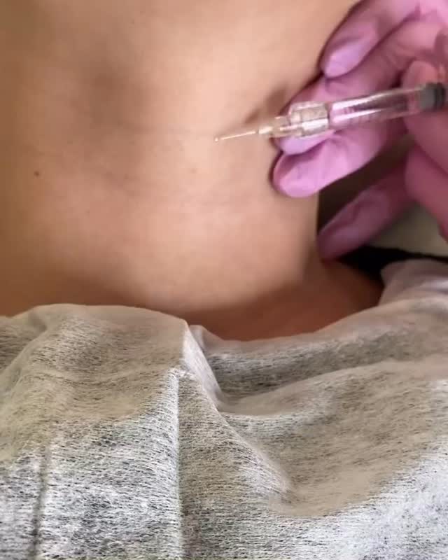 Blansching mit Belotero Soft💉
#deincosmetologist #blansching #falten #rottenburg #ästhetischemedizin