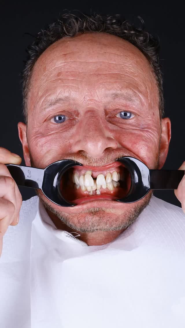 True transformation is found in the details.
Dear our patient Holger’s smile journey reflects the transition from worn, compromised teeth to a naturally white and healthy smile.
A process shaped by personalised planning, meticulous execution, and a refined balance between oral health and aesthetics.
This reels captures how a smile is carefully redesigned step by step.