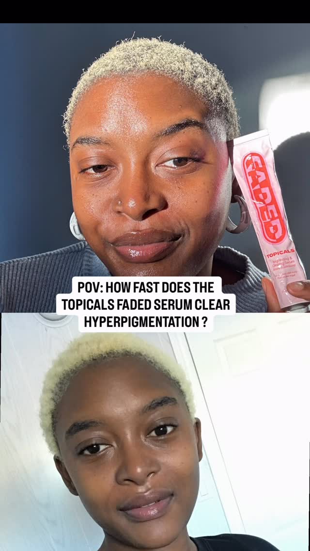 SLOW BURNER if there’s one to describe the @topicals Faded Serum that will be it!!
4 weeks in I was wondering if I had not just just wasted my money on yet another viral product bcz usually my skin responds to hyperpigmentation treatments around that mark.
It wasn’t until 6 weeks in that my skin began changing. It literally felt like I work up and morning and boom… my skin had started changing 🤣
That’s why consistency in skincare is so important. While it took 3 moths to get significant results I used for 5 months in total until my sister stole my tube 😭
In terms of actives we have a cocktail of kojic, tranexamic, azelaic acids , Niacinamide, licorice root extract, melatonin, turmeric extract all packed in a gentle and hydrating formulae that won’t irritate the skin (I have sensitive skin and it worked for me)
So if you are more interested in long lasting results over a “7 say miracle” transformation maybe give this a go.
If you already have a hyperpigmentation treatment in your routine and it’s working for you no need to switch to this one 😊
#skincareroutine #hyperpigmentation #topicals #darkspotserum