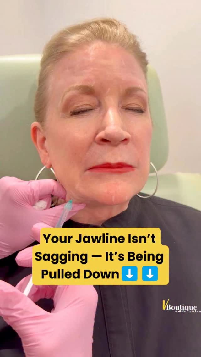 ✨ Watch until the end to see real patient results! ✨
Did you know we can reshape and lift the jawline without surgery—by working with your facial anatomy, not against it? 💉✨
Recent studies show that injecting neurotoxins like Dysport or Botox into the platysmal bands (the neck muscles that pull the jawline down) helps release those downward forces ⬇️
This allows the opposing muscles of the mid and upper face to lift upward, unopposed ⬆️✨
The result?
✔️ A tighter, more defined jawline
✔️ Improved appearance of the upper neck
✔️ Subtle lifting and repositioning of soft tissue in the mid and upper face—with restored volume, naturally 💫
This technique was once called the Nefertiti Lift, but it has evolved. Today, it includes precise injections along the upper and lower jawline, targeted treatment of the platysmal bands, and—when needed—as in this case, a touch of hyaluronic acid filler to enhance structure and definition without adding bulk or squaring the face 🤍
🧠✨ This takes expert assessment and precision.
Every face is different. Every protocol is customized. There is no one-size-fits-all in aesthetic medicine.
Sometimes we add lasers for tightening 🔥
Sometimes we treat the masseters to reduce jaw bulk 💉
📲 Call or text us at 561-357-2020 to make an appointment!
#JawlineLift #NefertitiLift #BotoxResults #FacialBalancing #AestheticMedicine