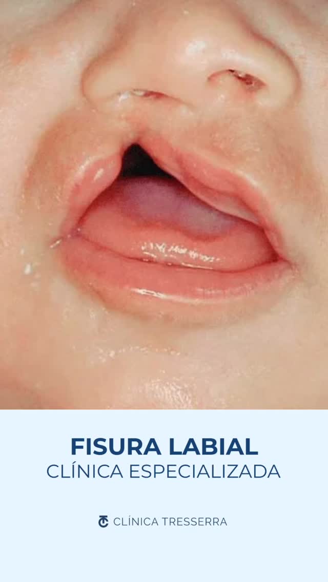 💙 Antes y después que cuentan una historia de vida.
Este cambio es el resultado de un proceso médico complejo, planificación precisa y un seguimiento constante.
Pero, sobre todo, es el reflejo de cómo una intervención a tiempo puede marcar la diferencia en la vida de una persona.
Detrás de cada imagen hay una familia, un equipo médico y un camino recorrido con confianza y esperanza.
💬 ¿Qué es lo que más te emociona de este resultado?
📩 Comparte este antes y después con quienes puedan necesitar este mensaje hoy.
#FisuraLabial #AntesYDespués #ClínicaTresserra #CirugíaReconstructiva #fisuralabiopalatina