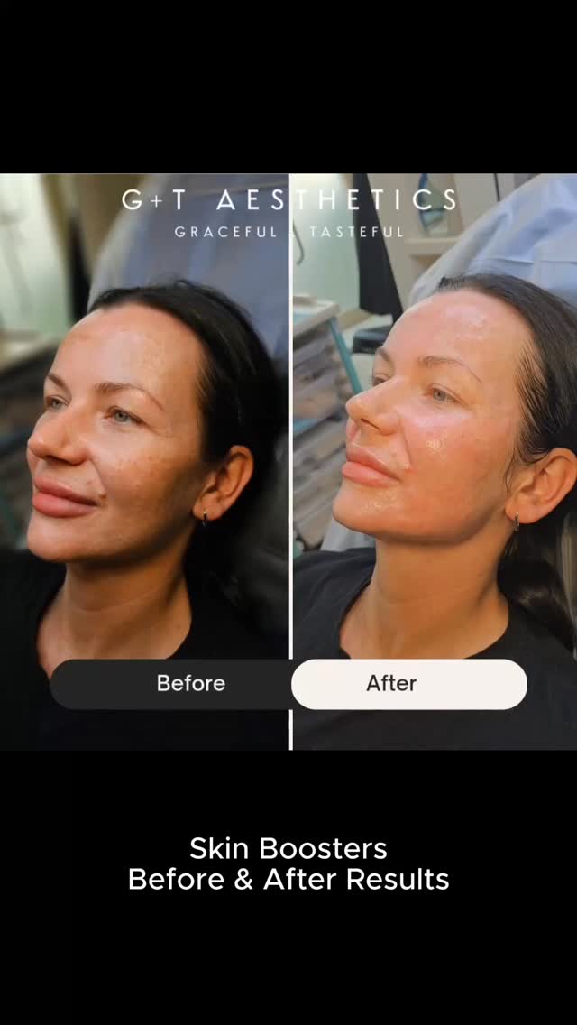 See the transformation in action ✨
Skin boosters work beneath the surface to enhance hydration, texture, and tone.
Perfect for clients looking for subtle, natural rejuvenation.
📲Enquire or visit www.gtaesthetics.co.uk for more info.
#SkinBoostersResults #BeforeAndAfter #AestheticClinic #HealthySkin #StamfordAesthetics #JaluproTreatment