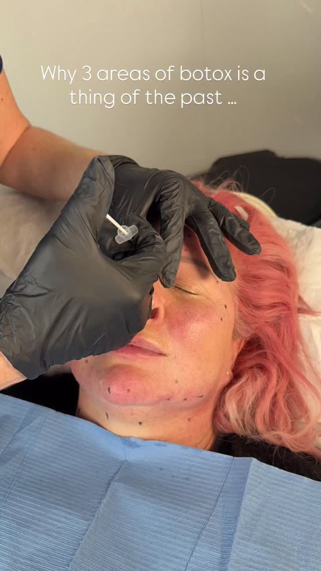 Why “3 areas” is a thing of the past!
Botox techniques have advanced massively over the years, it’s clear that faces don’t age in neat little boxes. They age through muscle pull, imbalance and downward tension …. particularly around the eyes, neck, jaw, jowls and mouth.
If Botox has ever left your forehead smooth but you still felt heavy, tired or aged elsewhere, this is why.
When it comes to advanced Botox, seeing an experienced practitioner is key. A tailored, full-face approach allows us to treat areas that truly affect how the face lifts and ages.
Some of our favourite areas to treat include:
• Brow lift to soften heaviness around the eyes
• Jelly roll under the eyes to smooth and reduce lines
• Jawline and jowls to lift and tighten
• Neck to reduce creases, sagging and lines
• Around the lips to soften smoker’s / pout lines
• The lips for a subtle lip flip to refresh shape and balance
This approach is perfect for those who want to lift the face and neck, giving fresh look without using filler.
Come and see us for a free consultation, just drop us a DM today and we’ll talk you through your options.
Payment plans available , just ask your consultant for details when you chat.
📍 Ultra Aesthetics — Liverpool