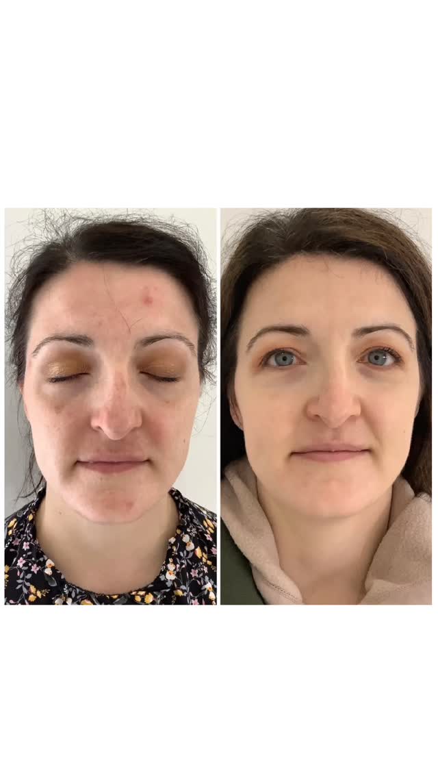 @ The KS Clinic we are awarded skin specialist of the year 6 times for a reason.
We have a profound understanding of skin and what it needs. Along with 20 years experience and a drive for elevating your self confidence.
If you are tired of trying to treat your skin concerns and want professional help contact us today.
07907792829
Oldbury, B69 4DS
Booking link in bio
#skinclinic #oldbury #clearskin #cosmelan #skinclinicbirmingham