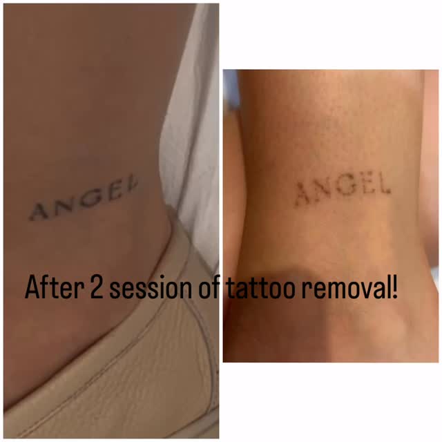 💫Real results. Real progress.
Tattoo removal is a journey—and this before & after shows just how powerful the process can be. 🖤
DM us to start yours.