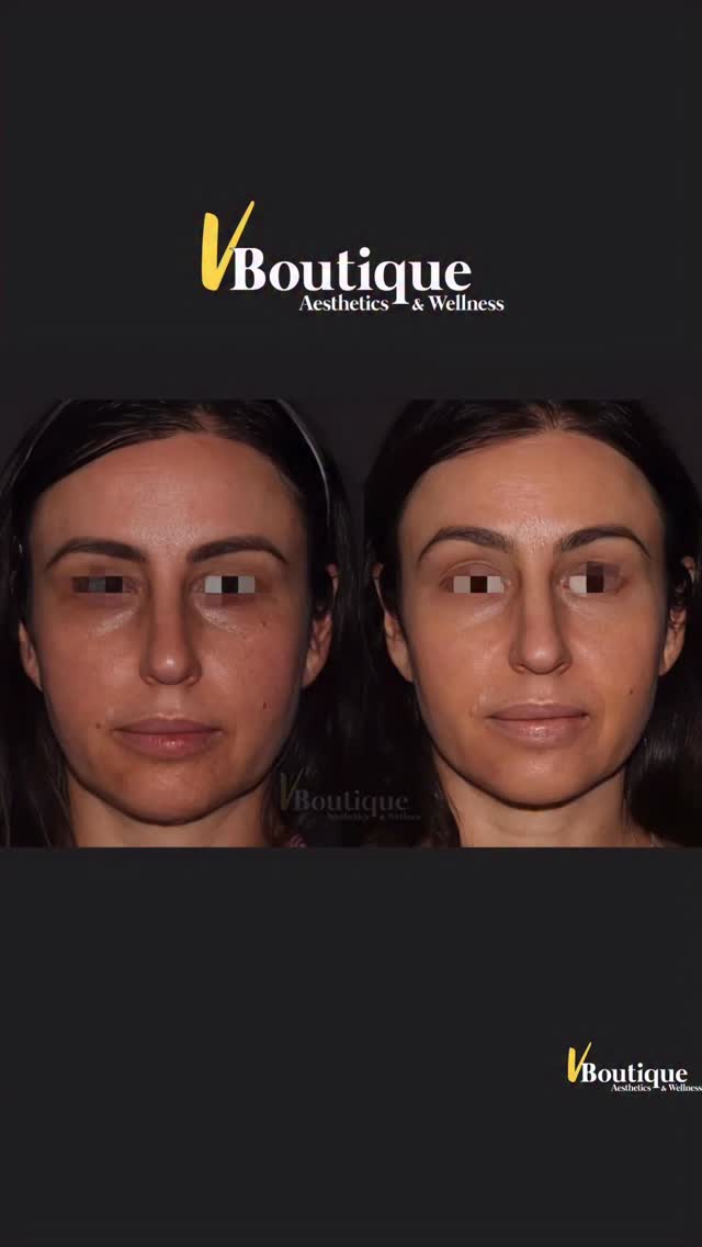 ✨ REAL RESULTS. REAL LONGEVITY. ✨
One year later — and still glowing. 💫
This before & after shows the power of Fotona 4D non-surgical facelift when it’s done thoughtfully, comprehensively, and customized to the patient.
👉 These results are ONE YEAR after treatment.
📌 Treatment details
• 3 sessions of Fotona 4D
• LipLase included 💋
• ❌ No Botox
• ❌ No Dysport
• ❌ No filler
• ❌ No other lasers or interventions
Just the body’s own regenerative response. 🌱
🔬 What is Fotona 4D?
Fotona 4D is a four-step laser facelift that works through all layers of the skin, starting inside the mouth and moving outward to the surface using multiple laser wavelengths at different delights and for different targets in the skin— something no single-step treatment can do.
✨ What you’re seeing here (1 year later):
✔️ Improved skin quality & glow
✔️ Reduced discoloration, redness & dark spots
✔️ Smoother texture and brighter tone
✔️ Lift and repositioning of cheek soft tissue ⬆️
✔️ Improved jowls with tighter jawline & neck definition
✔️ Healthier, more hydrated lips with better texture (LipLase 💋)
💡 Results are noticeable immediately after treatment with continued tightening and improvement over months — and as you can see, they last.
⏱️ Zero downtime
🎯 Fully customized based on anatomy & goals
🌿 Stimulates your own collagen — no artificial volume
Thank you to our beautiful patient for trusting us and allowing us to share her journey. 🤍
#Fotona4D #NonSurgicalFacelift #OneYearResults #LaserLift #SkinTightening