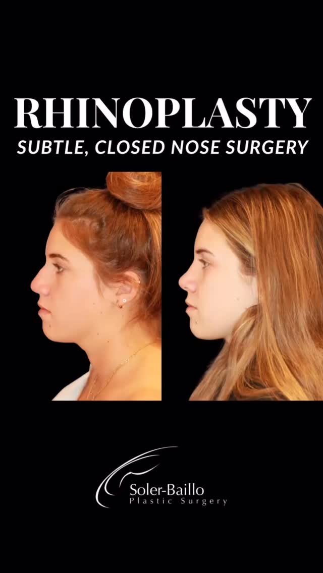 👃Precision, proportion, and natural balance.
Closed rhinoplasty allows for internal structural refinement while preserving external soft tissue integrity and minimizing visible scarring.
💬 Discover if this approach is right for you!
📞 305-661-1996
#rhinoplasty #rhinoplastybeforeandafter #closedrhinoplasty #drsolerbaillo #plasticsurgerymiami