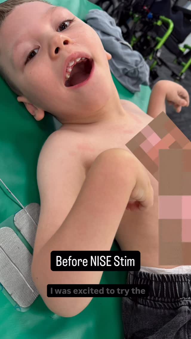 ✨NISE-Stim Tone Modulation✨
A few weeks ago I completed the NISE-Stim level 2 course with the incredible @spinalstimgerti. One part of the course is tone modulation, using electrical stimulation at a sensory level to lower spasticity and increase awareness.
I was so excited to try this technique on Mr A, a gorgeous smiling 6 year old with cerebral palsy. I placed electrodes on each limb and watched within seconds as his body relaxed.
The great thing about NISE-Stim is that his family can do it at home and use it during other therapies. The hope is that Mr A will feel more comfortable and be able to use his arms more functionally.
#spinalstim #physiotherapy #cerebralpalsy #spasticity