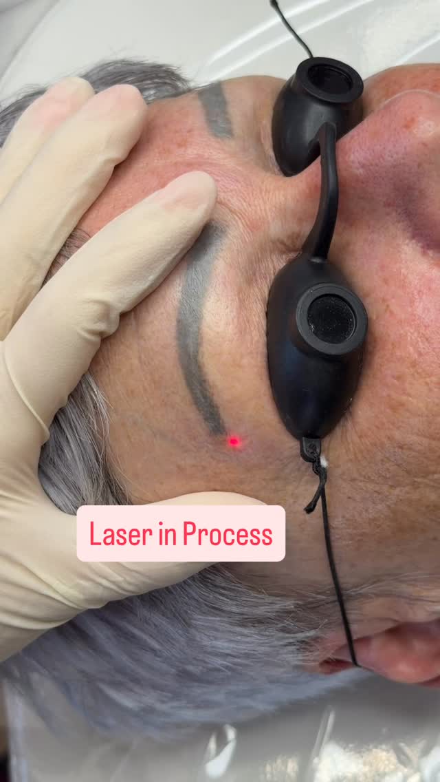 💁♀️Another Laser removal for tattooed brows done elsewhere to make them ready for Nano Hairstrokes💪
#laserremoval #eyebrowfix #eyebrowcorrection #wellingtoncosmetictattoo