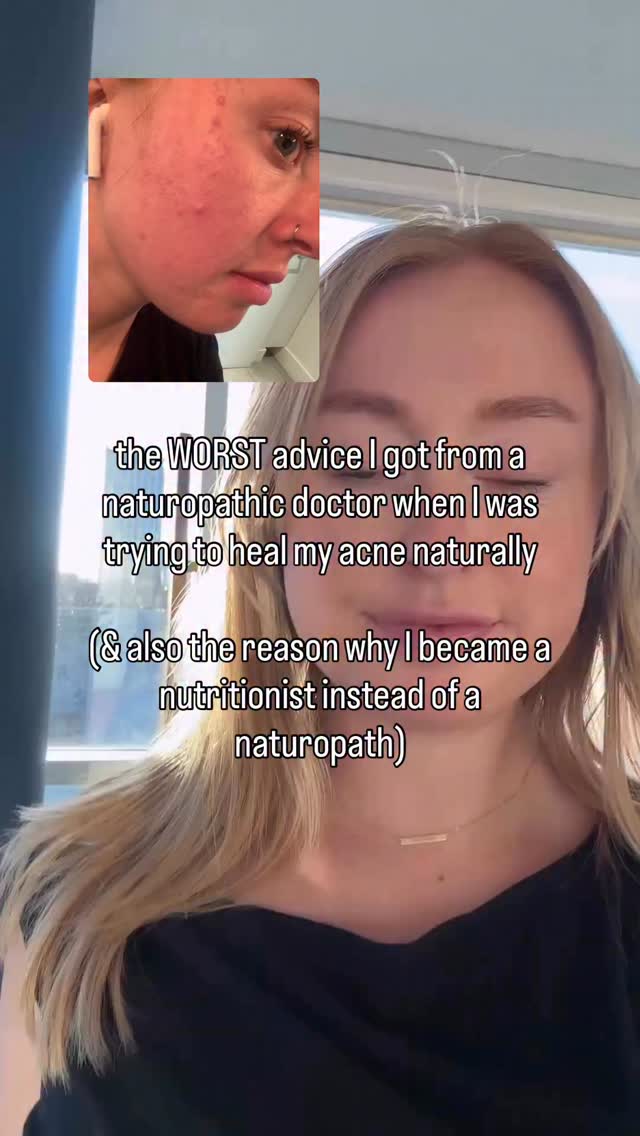 When I came off birth control and developed chronic acne, missing period, bad anxiety/panic attacks, hair falling out, terrible gas… I had no idea how to get help (my family doctor was useless)! 🫠
But I eventually came across naturopathic medicine and fell in love with it. I worked with a naturopath pretty early on in my healing journey and she was great but there was always one thing that didn’t sit well with me.
She replaced pharmaceutical drugs with supplements. Every symptom got its own pill.
Acne → zinc, vitamin A, DIM
No period → chaste tree, maca
Anxiety → magnesium, adaptogens
Digestion → enzymes, betaine, probiotics
Hair loss → biotin, iron, silica
It was the exact same model as conventional medicine… just “natural”.
Nothing was tying the symptoms together.
Nothing was asking why my body was struggling in the first place.
Very little testing was recommended to see what my body actually needed.
I had one system that was heavily dysregulated which affected all my other systems. There was no need to chase each individual symptom with a supplement. That’s not how you heal from the root cause.
This realization changed everything for me because I kept wondering why my acne would clear and then come back, clear and come back. Well that was why. The root issue was never addressed.
I was overwhelmed with a 10 step supplement routine that was just playing whack a mole with my symptoms.
Supplements should support the body while you get to the root cause.
I have no resentment towards this naturopath, this is what she was taught in school to do. But this is ultimately why I made the decision to back out of naturopath school last minute and enrol in a holistic nutrition program. I knew there was a better way.
Fast forward to now, my skin is clear, hormones are balanced, digestion is optimal and I have used my two nutrition certifications to develop a thriving practice healing over 500 women’s skin naturally from the root cause (so it doesn’t come back).
If you’re new here, start with my free masterclass- link in bio! 💛
#acnehealing #acnesolution #clearskingoals #holistichealthjourney