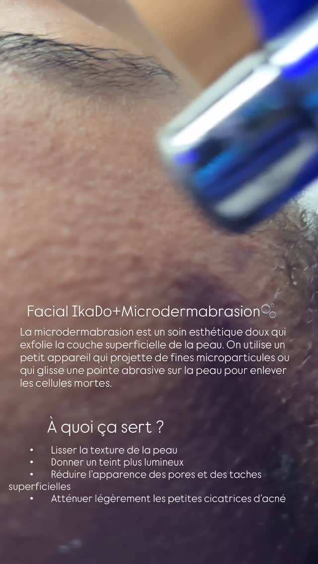 Facial IkaDo +Microdermabrasion 🫧
⚫️Á pointe diamant : une pointe abrasive qui exfolie la peau pendant qu’un système d’aspiration enlève les débris
www.ikadoesthetique.com
ONGLET :Soins Visage