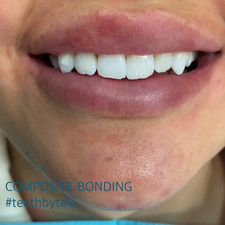 It’s so nice to be able to make a difference to people’s lives using treatments that keep teeth healthy
.
.
Invisalign, whitening and composite bonding in this case ⚪️💙.
.
.
#teethbyteki #invisalign #compositebonding