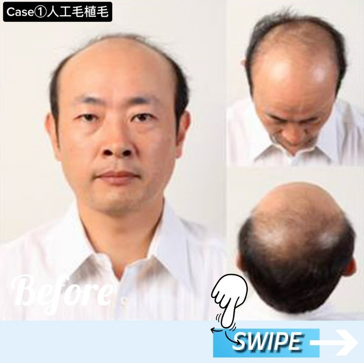 【人工毛植毛の体験者の声】
💁♂️K.S様
きっかけは、信頼のおける友人からの紹介だったので、人工毛植毛への不安は全く感じていませんでした。
一時期はカツラをと考えていましたが、友人が実際に人工毛植毛をしていた事もあり、直に頭皮から生えている人工毛は本物の髪と見分けが付かなく見え、早く自分も施術を行いたいという気持ちで不安感は全く感じませんでした。
植毛後に鏡を見て驚いた事は、植毛前にカウンセラーに要望した髪型通りに仕上がり、期待していた以上の出来栄えでした。
翌日から通常勤務が出来、植毛前に営業職という立場から毎日お会いする沢山の方々に「○○日以降、私、髪の毛フサフサに変ります!」と宣言してまわったのですが、 植毛後に聞いた感想は、「若くなった!」「植毛ってこと全然わかんないね!」「かっこよくなった!」など、涙が出るほど嬉しい声を聞きました。中には、「大爆笑しようと思って楽しみにしてたのに、自然過ぎてつまんない!」なんて方もいらっしゃいましたが…(笑)
また、古くからの友人には、「昔の顔に戻った感じがするね!」と言われました。自分としても、髪の毛が復活したというよりは、元々の自分の顔を取り戻せたというのが率直な感想です。
さらに、髪の毛に悩みを持つ方にもこんなことを言われました。
「いやあ、すごい技術だね!本当に自然だねぇ!」
カツラや髪の毛を貼付けるタイプだと、何かニセモノ感や後ろめたさを感じるようなイメージがあるが、人工毛植毛は実際に髪の毛が自然に生えているのと同然!と言われ、まったくそう言った後ろ向きな感覚がありませんでした。
自分自身がそうであったように、今後は髪の毛で悩んでいる人がいたら、積極的に人工毛植毛をお勧めして、この感動を分かち合いたいと思います。
•*¨*•.¸¸☆*・゚•*¨*•.¸¸☆*・゚•*¨*•.¸¸☆*・゚•*¨*•.¸¸☆*・゚
◯メリット
理想のヘアスタイルを実現できる
本物の髪の毛ではないため、植毛する本数や長さを自由に調節できるという特長があり、理想のヘアスタイルが実現できます。
●人工毛植毛のデメリット
術後に炎症を起こす場合がある
質感、色味が不自然になることがある
植えられた髪は伸びない
定期的にメンテナンスが必要
•*¨*•.¸¸☆*・゚•*¨*•.¸¸☆*・゚•*¨*•.¸¸☆*・゚•*¨*•.¸¸☆*・゚
他の投稿が見たい方は▼
@nidoclinic.sapporo
ご予約・詳しい詳細はプロフィール欄よりお進みください☺️
•*¨*•.¸¸☆*・゚•*¨*•.¸¸☆*・゚•*¨*•.¸¸☆*・゚•*¨*•.¸¸☆*・゚
AGAは正しい知識をもって治療を行う事が大切です。
まずはお気軽に無料カウンセリングにお越し下さい☺️
良ければ【いいね&(フォロー】をお願いします✨
いつでも見返せるように【保存】もよろしくお願いします🙇♂️
•*¨*•.¸¸☆*・゚•*¨*•.¸¸☆*・゚•*¨*•.¸¸☆*・゚•*¨*•.¸¸☆*・゚
ニドークリニック札幌
◼️所在地
📍北海道札幌市中央区南1条西6丁目11番 札幌北辰ビル7階
◼️営業時間
⏰9:30~18:00(受付17:00まで)
🗓️定休日:木曜、第1・3日曜、他隔週月曜
◼️お電話でお問い合わせの際は「Instagramを見た」と仰っていただけるとスムーズです。
📞011-281-0210
•*¨*•.¸¸☆*・゚•*¨*•.¸¸☆*・゚•*¨*•.¸¸☆*・゚•*¨*•.¸¸☆*・゚
#ニドークリニック札幌 #ニドークリニック #植毛 #自毛植毛 #植毛手術 #薄毛治療 #薄毛改善 #薄毛対策 #薄毛が悩み #薄毛 #aga #aga治療 #aga治療薬 #北海道 #札幌 #札幌駅 #大通り#薄毛女子 #女性の薄毛治療 #ハゲ対策 #ハゲ改善 #植毛札幌 #植毛職人 #植毛名医