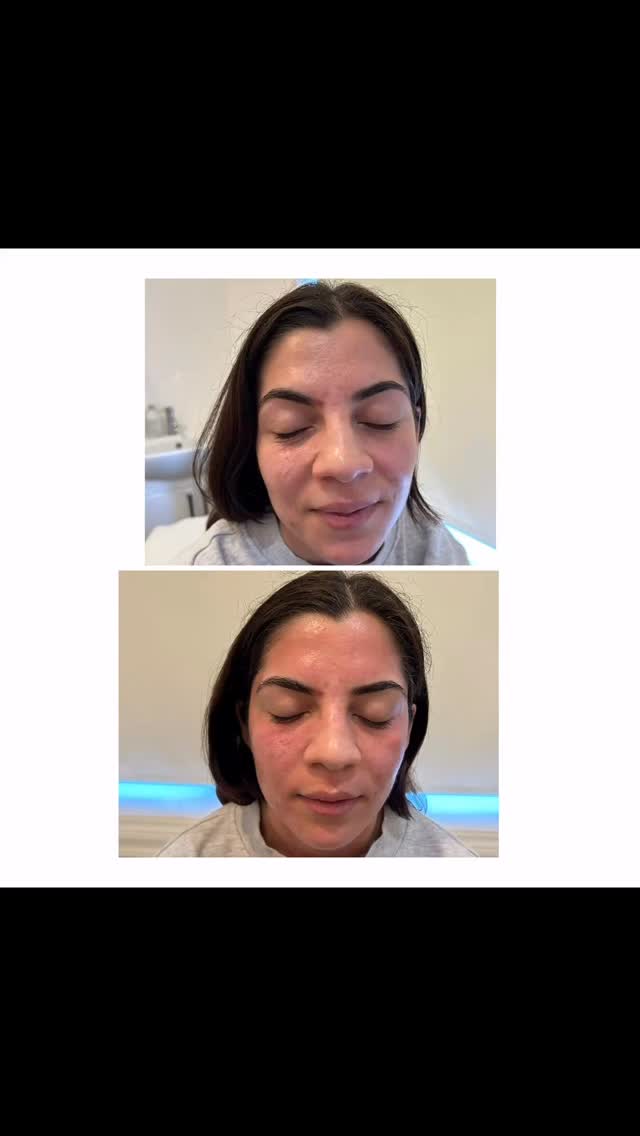 Before ➡️ After microneedling ✨
Microneedling works by creating tiny micro-channels in the skin, triggering collagen production and skin renewal.
Great for:
✔️ Texture
✔️ Fine lines
✔️ Acne scars
✔️ Overall skin quality
Consistency is key for best results.