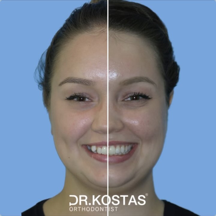 If you are looking to improve your smile and boost your self-confidence, you found the right place. Denisa trusted us her smile and the results were stunning 🤩. Book your Free initial consultation with Dr. Kostas and find out how we can help you get the smile you’ve always wanted.
#drkostas #kostasortho #orthodontist #braces #dublinbraces #smile #smiletransformation #dublinorthodontist #smilemakeover #dublin #orthodontics #straightteeth #teethstraightening #damonbraces #smiletransformation