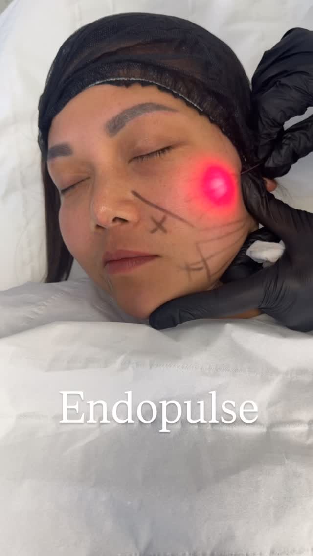 IN HIGH DEMAND !!!
Endopulse / Endolift non surgical face lifting / skin tightening.
Endopulse is a minimally invasive laser treatment for non-surgical skin tightening, fat reduction, and facial/ body contouring, using micro-optical fibers inserted under the skin to deliver precise laser energy, stimulate collagen, and remodel tissue for a younger, lifted look with minimal downtime, ideal for areas like the face, neck, and body.
£999 for a limited time only! Original price £2000-£2500.
Results last up to 3 years.
#endopulse #endolift #endolaser #endosculptbrowlift #skintightening