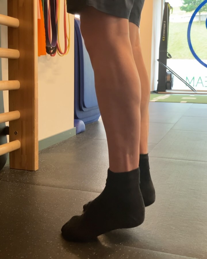 Rolands erste ,,Calf Raises‘‘. Seit seiner Achillessehnenruptur von vor 7 Wochen macht er stetige Fortschritte, hat seinen Stützschuh abgelegt und ist dabei seine Gangstrecke ohne Gehhilfen weiter zu erhöhen.
Slide 1: Sicher kann man die Form hier noch ausbauen aber man lernt nichts wenn man nur das macht was man kann. Das Update bekommt ihr dann in ein paar Wochen. Stärke und Kontrolle in endgradiger Dorsalextension (Fussbeugung) und Plantarflexion (Fussstreckung) ist hier das Ziel.
Slide 2: Ziel dieser Übung ist es Roland daran zu gewöhnen sein Gewicht wieder mehr auf den Mittelfuss zu bringen da er durch das Laufen im Stützschuh stetig in einer gestreckten Fussposition fixiert war.
Slide 3: Damit auch die Abstossbewegung beim Gehen nachher wieder flüssiger wird, kann man in der gleichen Position schonmal leichtes Gewicht auf den gestreckten Fuss geben.
Slide 4: Wir bewegen uns von der Beinpresse mehr und mehr zu Squatvariationen um den gesamten Unterkörper zu kräftigen und Roland Sicherheit dabei zu geben sein Knie über die Zehen zu schieben.
Slide 5: Rolands erste Schritte ohne Stützschuh von vor 2 Wochen (5 Wochen nach dem Unfall). Man sieht wie er eine saubere Abrollbewegung vermeidet und das Knie sehr gestreckt hält um die Ferse zu entlasten. Dies aufzuheben ist das Ziel der nächsten Wochen.
Falls ihr Fragen zum Therapieprozess oder Übungen habt, lasst es uns gerne wissen :)
#horgen#physicaltherapy#physioteam#interview#zürich#sportsphysio#dontforgettotrain#achillesrupture