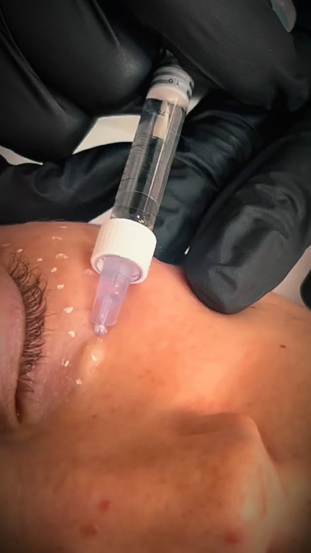 Biology over filler.
Polynucleotides don’t add volume.
They don’t freeze expression.
They repair, rebuild, and regenerate skin at a cellular level ✨
Think stronger tissue, healthier collagen, calmer inflammation, and skin that actually functions better — not just looks better.
This is regenerative aesthetics.
Quietly powerful. Scientifically smart.
And very much the future.
#AestheticMedicine
#RegenerativeAesthetics
#SkinRegeneration
#AdvancedAesthetics
#AestheticTraining