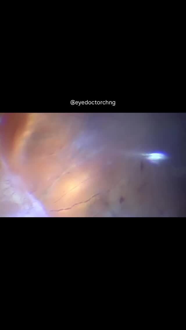 Look carefully at the retinal blood vessels … observe the live cattle tracking movement of the red blood cells in a case of a redo diabetic tractional retinal detachment surgery.
#diabeticretinopathy #retinaldetachment #vitrectomy #ophthalmology #eyedoctorchng