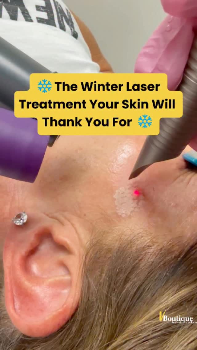 ✨ Precision resurfacing.✨
In this reel, I’m performing fractional Erbium:YAG laser resurfacing—a powerful yet customizable treatment designed to rejuvenate the skin from the inside out.
We begin with gentle, targeted resurfacing to precisely remove a dark spot—almost like delicately shaving the lesion for immediate clarity ✂️✨
Then we transition to fractional resurfacing, creating controlled micro-injuries in a fractionated pattern while leaving healthy skin intact in between.
🔬 These micro-channels trigger the skin’s natural healing response, stimulating new collagen and elastin, leading to:
• Improved skin tone & texture
• Softened fine lines & wrinkles
• Reduction in hyperpigmentation & dark spots
• Fresher, smoother, more radiant skin ✨
💡 Downtime is fully customizable
From barely-there sunburn-like peeling to...
➡️ up to 7 days of redness, crusting, and peeling—
In this patient’s case, we tailored the treatment for ~4–5 days of downtime, perfectly aligned with her schedule.
Every laser session is customized based on:
✔️ Skin tone & color
✔️ Age & skin quality
✔️ Lifestyle & social downtime availability
To optimize healing and results, we paired this treatment with:
🧴 Personalized pre- & post-procedure skincare
🧬 Topical exosomes (stem-cell-derived messengers) to accelerate recovery, reduce downtime, and enhance regeneration
❄️ Pro tip: Winter is the ideal time for laser resurfacing—less sun exposure, shorter days, and safer healing.
☀️ Sun protection is always essential, especially when fresh skin is healing.
#skinrejuvenation #laserskinresurfacing #glowingskin #fractionallaser #aestheticmedicine