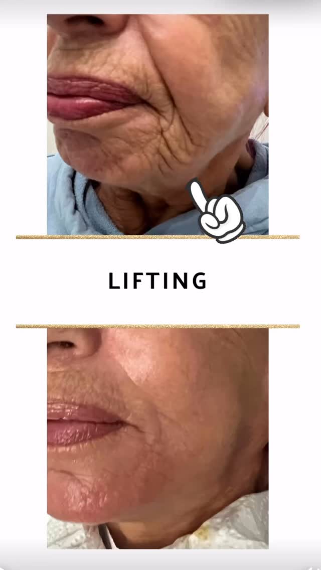 ✨ Lass dich von mir verwöhnen & sanft verjüngen ✨😍
Gönn dir eine kleine Auszeit nur für dich 💆♀️💫😎
Mit nur einer einzigen Behandlung kann deine Haut sichtbar gestrafft und frischer wirken – glaub mir.❤️🤍
Du wirst dich danach so wohl, so schön und so selbstbewusst in deiner Haut fühlen ✨
Weil du es verdienst, zu strahlen 🌸
📩 Schreib mir für mehr Infos oder deinen Termin
#lifting #hautstraffung #antiaging #antiwrinkletreatment