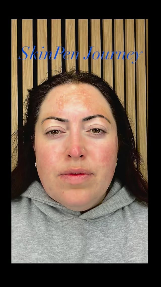 SkinPen Journey: Real Skin, Real Results!
Our manager Stacey here at English Rose Beauty House began her SkinPen microneedling journey to address post-natal melasma—a concern so many women experience after pregnancy.
After just 3 sessions, her skin transformation has been nothing short of incredible: brighter, more even, and visibly healthier.
We’re so proud to support her through this journey and even happier to see such powerful results achieved with a treatment we truly believe in.
Before & after results after the full course coming soon — stay tuned!
If post-natal pigmentation or uneven skin tone is something you’re struggling with, SkinPen could be the game-changer you’ve been waiting for.
📩 DM us to book a consultation or to learn more.
#CambridgeBeauty #CambridgeSkincare #CambridgeAesthetics #CambridgeSkinClinic #CambridgeFacials
SkinPenCambridge MicroneedlingCambridge MelasmaTreatment PostNatalSkin
PigmentationTreatment SkinTransformation CambridgeMums CambridgeWomen
EnglishRoseBeautyHouse AdvancedSkincare ResultsDrivenSkincare