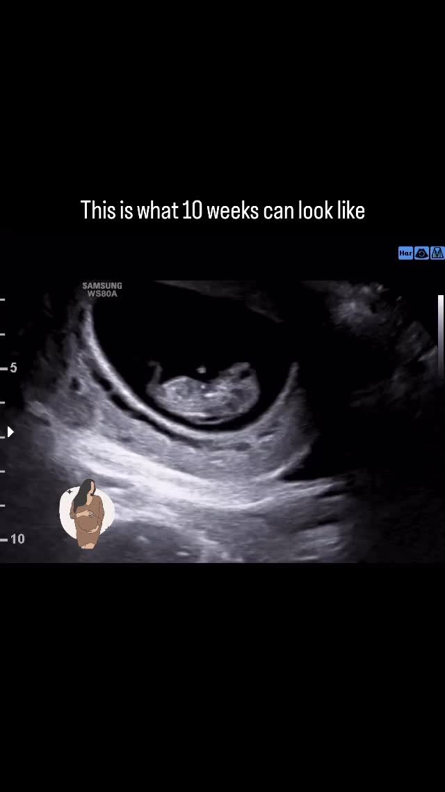 The little foot and fingers 😍
For many parents, seeing baby at 10 weeks brings peace of mind, reassurance, and a whole lot of happy tears. 🤍
#ultrasound #pregnant #pregnancy #firsttrimester #baby