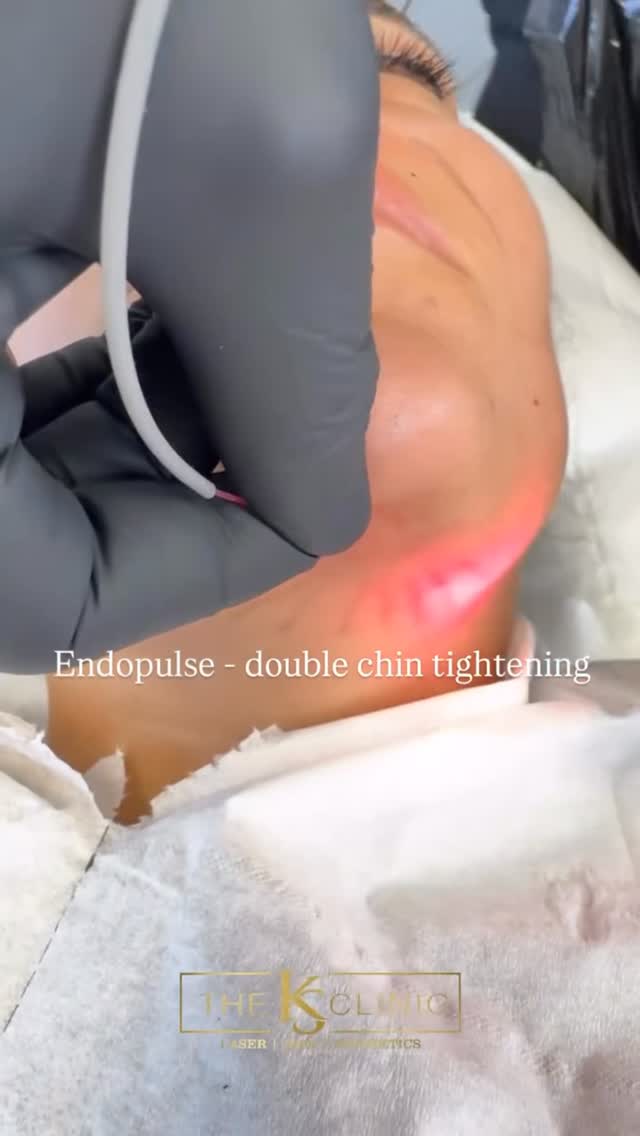 Endopulse is here,
The ultimate non surgical face lifting / skin tightening procedure (as seen on tv)
Forget radio frequency, forget Microneedling the results will never compare.
See 20% skin lifting / tightening straight away. Best results after 2-4 weeks.
Results last up to 2-3 years.
Minimally invasive treatment.
Book your consultation to discuss your desired area.
#endolift #endopulse #endolaser #skinclinicbirmingham #facelift