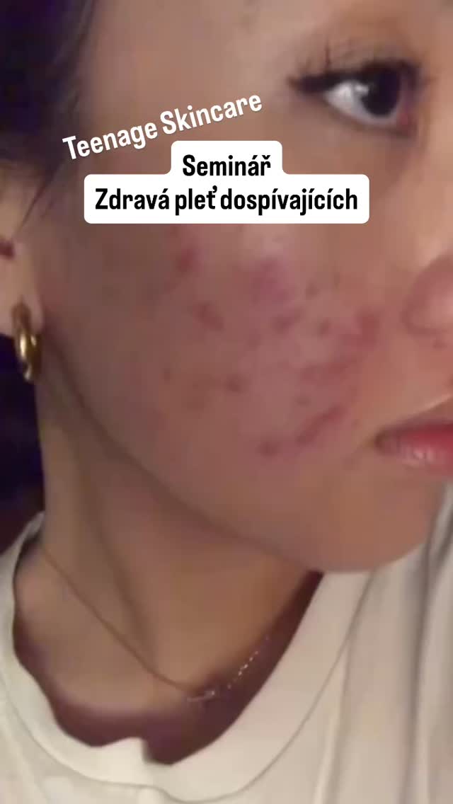 ✨Teenage akné nekončí zápisem na vysokou. Některé následky nesprávné péče si dospívající osůbka nosí od začátku puberty a vlivem nesprávné péče toto mnohdy ovlivní i stavy pleti v dospělosti.
💆🏻♀️Jako profesionálové bychom měli umět nabídnout vhodné řešení, zhodnotit, kdy lze či nelze pomoci a jak nasměrovat péči tak, aby minimalizovala následky.
✨Nebo máte doma dospívající ratolest 👧🏻👦🏻 a začínají první pupínky? Se svým dítkem se lze přihlásit na workshop pro rodiče a jejich děti, kde uslyší odborné rady ohledně péče přímo od kosmetičky a společně můžeme stav zkonzultovat 🙌
Seminář pro odborníky 👉 www.koseon.eu
Workshop pro rodiče a děti 👉 www.joseon.cz
Místa omezena 🙌
#skincare #teenagegirls #teenageboys #dospivajici #peceople školení kosmetiček