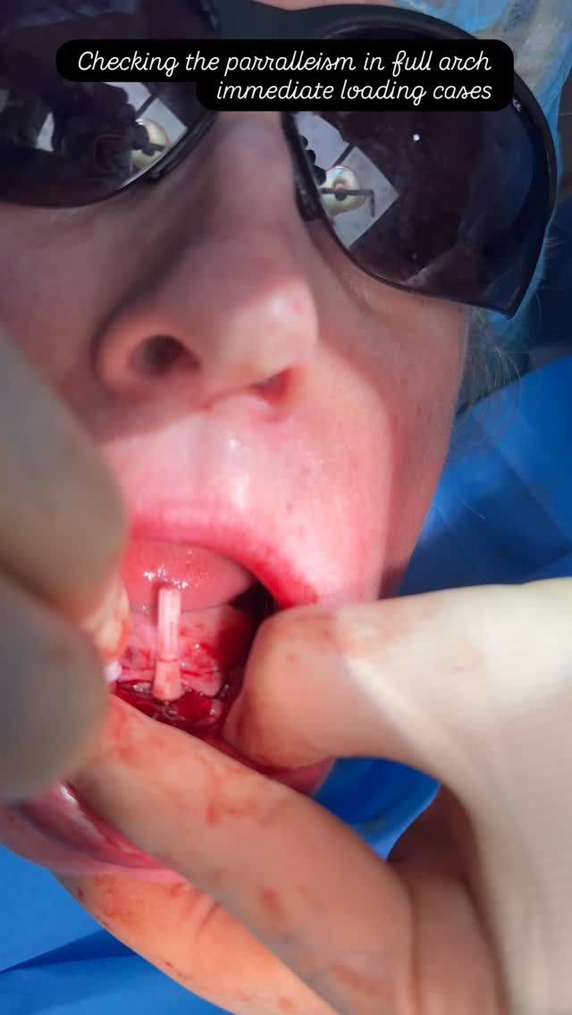 This is how you check the parallelism in full arch immediate loading cases. #dentalimplantmanchester #fullarchdentalimplants #teethinadaymanchester #smilemakeovermanchester #allon4manchester