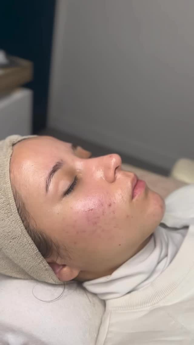 ** Acné traitement**
✨Soin LED Thérapie disponible chez @sela.beaute ✨
#acné #soinvisage #estheticienneconflans