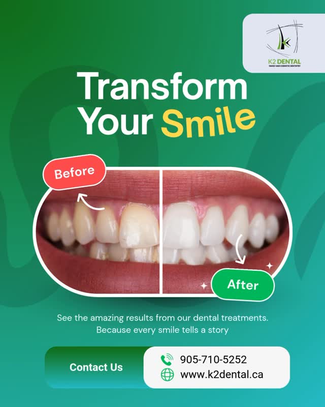 💚Transform your smile 😁
✔️See the amazing results from our dental treatments—because every smile tells a story.
Before & After
📲905-710-5252
🌐 www.k2dental.ca
#K2Dental #BeforeAndAfter #SmileTransformation #DentalResults #CosmeticDentistry
