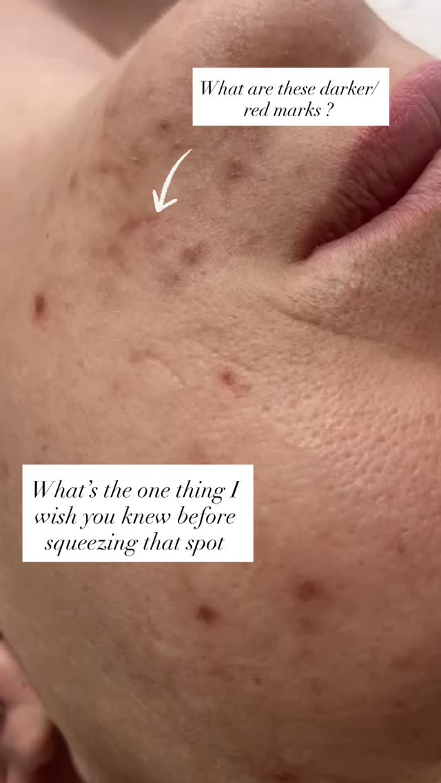 I want you to know that you may think that squeezing a spot gets rid of it!
On the contrary it aggravates, inflames, damages, scars and discolours your skin.
So you’re shifting one problem to another new one.
PIH stands for Post Inflammatory hyperpigmentation.
Skins of colour develop darker colours skin
Lighter develop Redish coloured skin
We can treat this with both preventative skincare and ingredients to lighten , brighten and help destroy this response
What happens if you don’t take this advise?
You will be left with scars , discolouration and a battered self esteem and damages and collapsed pores which will age you .
I can devise a simple step skincare plan to elevate results
DM for support
Anna ❤️
#postinflammatoryhyperpigmentation #acne #acnescaring #pigmentation #leightonbuzzard