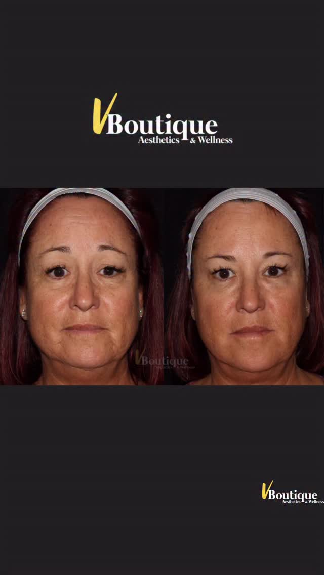 Small tweaks. Big shift. ✨
We are so grateful to our beautiful patient for allowing us to share her journey 🤍
In her before, you can see subtle features that unintentionally created a tired or slightly sad expression: downturn of the mouth corners, etched marionette and lip lines, mild lip thinning, tear-trough hollowing, and brows that sat a bit too high medially.
In her after, the transformation is soft, natural, and expressive 💫
• Brows gently repositioned for a more confident, balanced look
• Mouth corners lifted for a happier, brighter expression 😊
• Softened 11s, forehead lines, and crow’s feet
• Smoother marionette and lip lines
• Subtle lip hydration and shape with HA filler 💋
• Tear trough filler to restore a rested, refreshed appearance 😌
This was not a dramatic makeover — just a little filler in the tear troughs, lips, and perioral area, plus Dysport to lift and reposition the upper and lower face. The goal: a refreshed, well-rested version of her ✨
The most important step in aesthetic medicine is always the assessment 🧠
By understanding the expression she wanted to project, we treated the right areas and achieved beautifully natural results 💖
#NaturalResults #FacialBalancing #AestheticMedicine #Dysport #hyaluronicacid